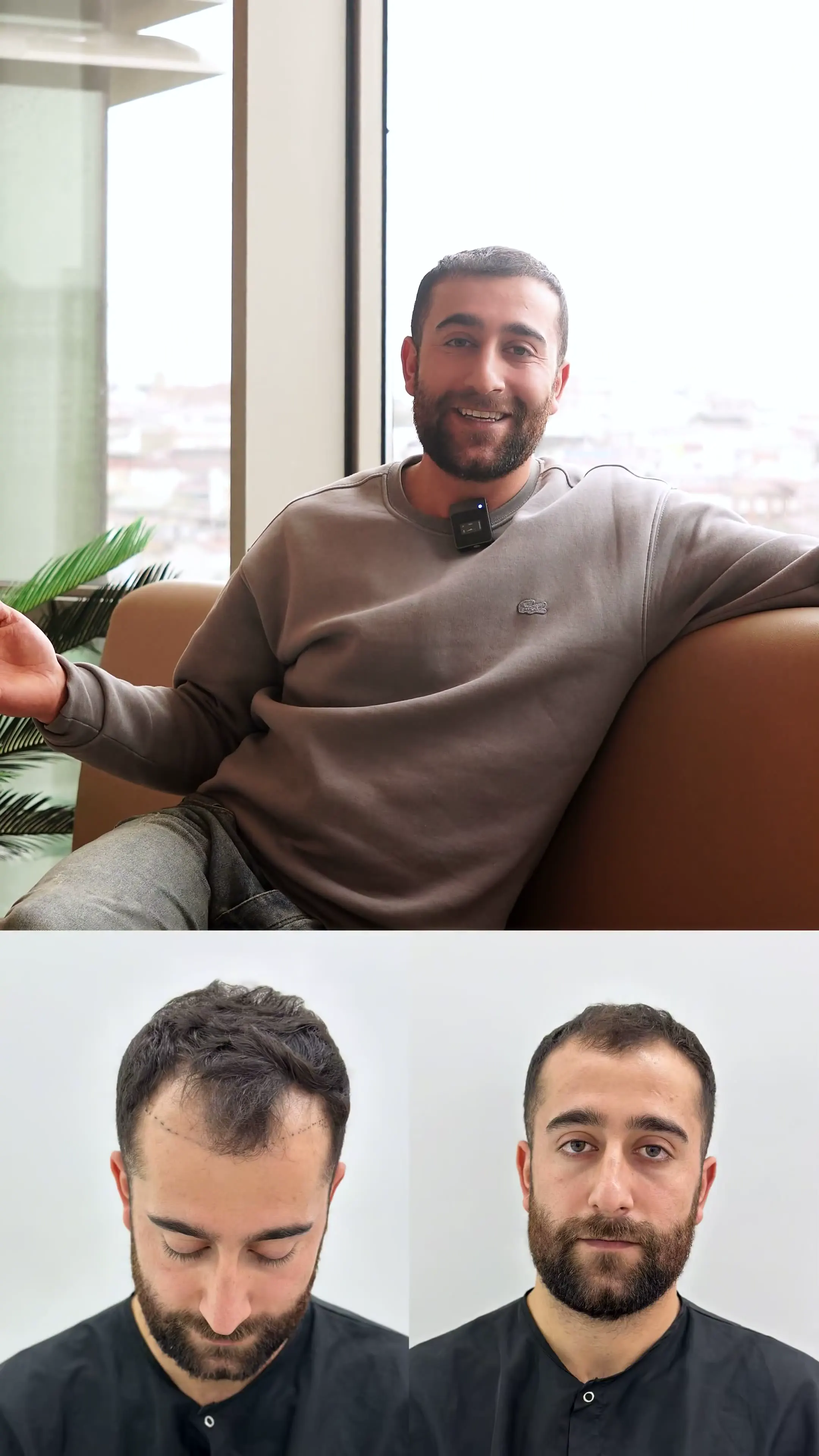 Leon Hair Turkey saç çizgisi sonucu